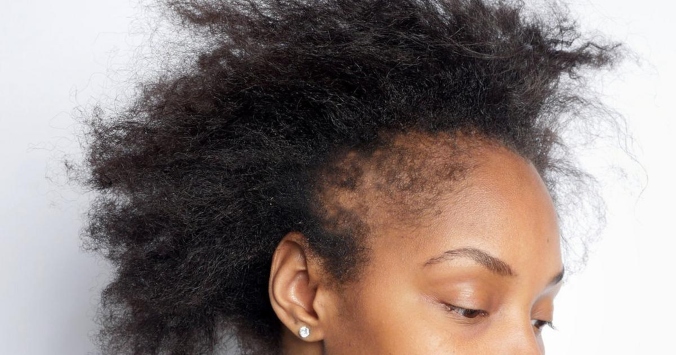 Minoxidil For Edges? Why Black Women Are Using This Unexpected Hair Growth Solution