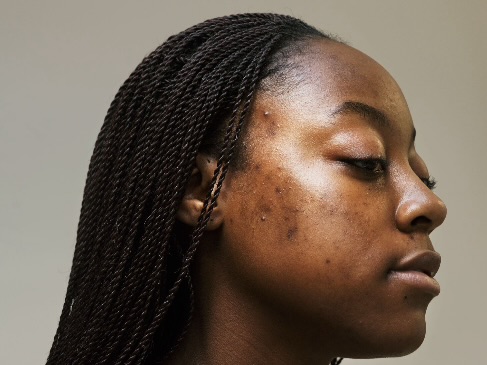 Hairline Acne: Causes, Treatments, And How To Protect Your Hair