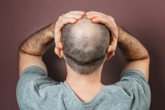 Battling Baldness: The Best Hair Loss Treatments For Men