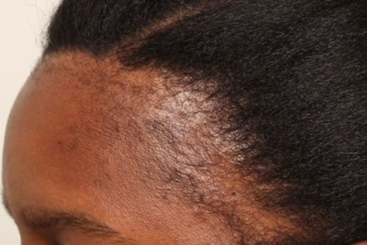 Frontal Fibrosing Alopecia: What You Need To Know About This Hair Loss Condition