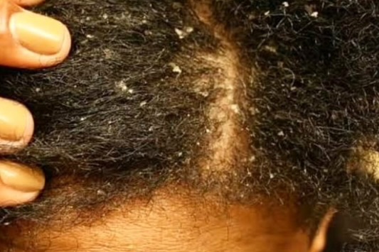 Scalp SOS: How To Tell If It’s Dandruff Or Seborrheic Dermatitis, And What Actually Helps