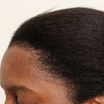 Hair Implant Aftercare 101: How To Heal Properly And Protect New Growth